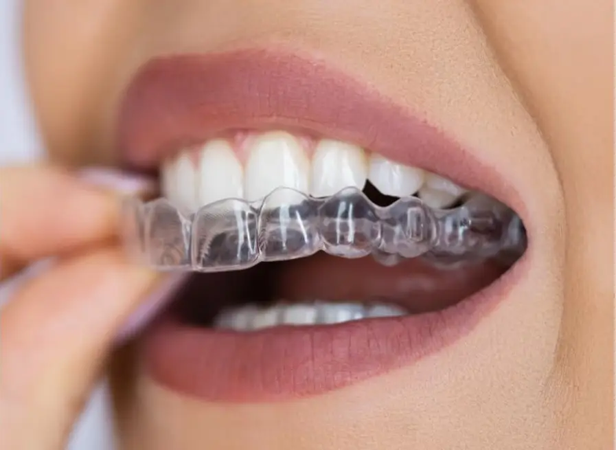 Patient applying clear aligner on upper teeth.