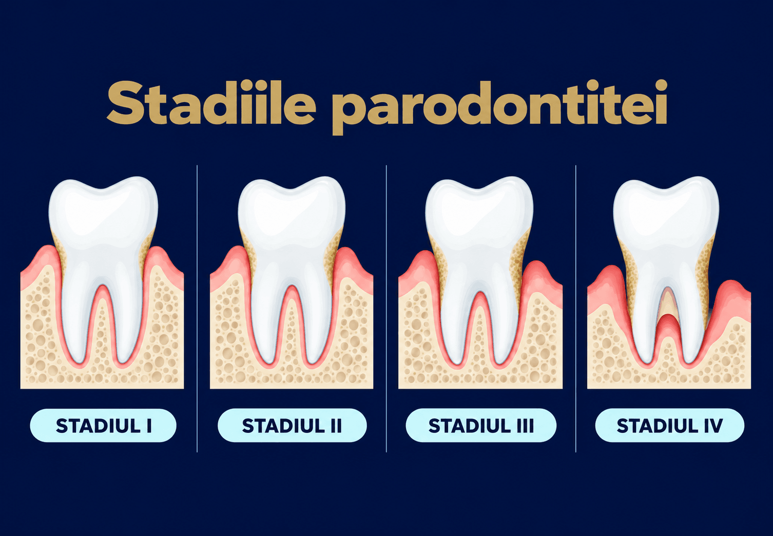 Stadiile parodontitei, de la stadiul I la stadiul IV, cu pierderea progresivă a țesuturilor de susținere