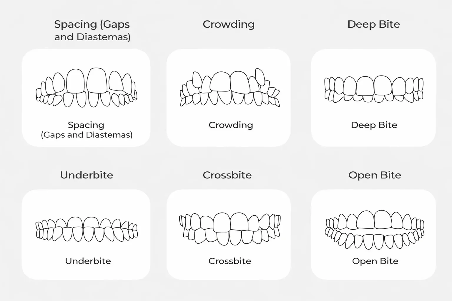 Types of malocclusion: spacing, crowding, deep bite, underbite, crossbite and open bite illustrated