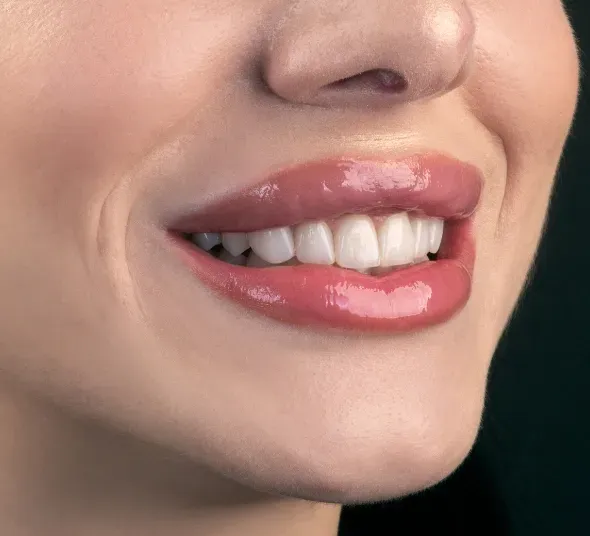 Rezultat Alexandra R | fatete dentare