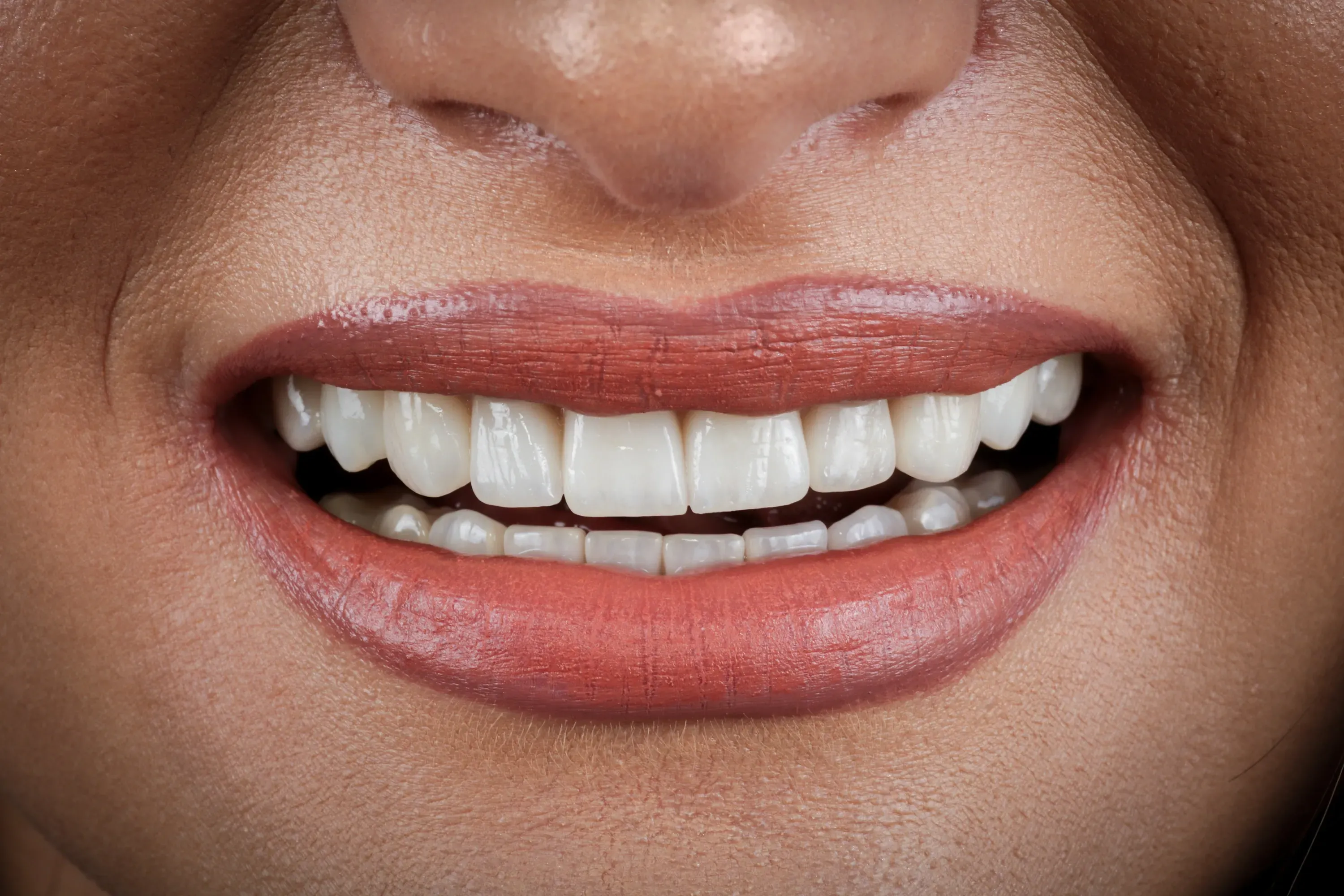Zambet After Georgeta P | Aparat dentar safir, implant si fatete