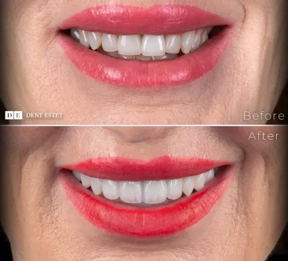 Before & After Oana Taban | Zambet inainte si dupa