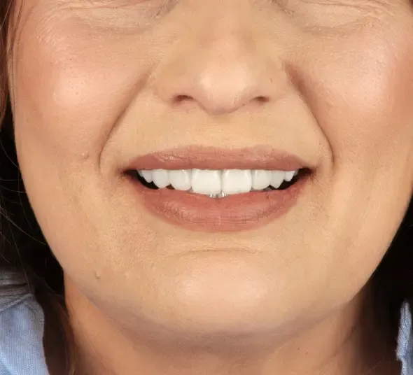 Zâmbet după tratament cu implant dentar Straumann și coroane dentare ceramice.