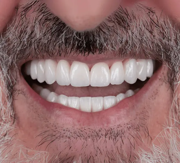 Zâmbetul lui Gavriil Pinte după tratamentul cu fațete EMAX și coroane ceramice