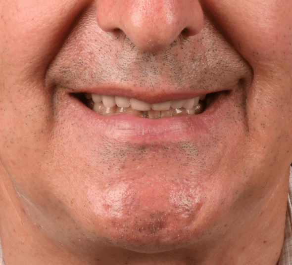 Zambet inainte de tratament cu coroane premium din zirconiu și alignere dentare.